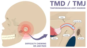 tmj disorder treatment