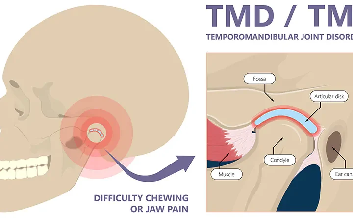 tmj disorder treatment