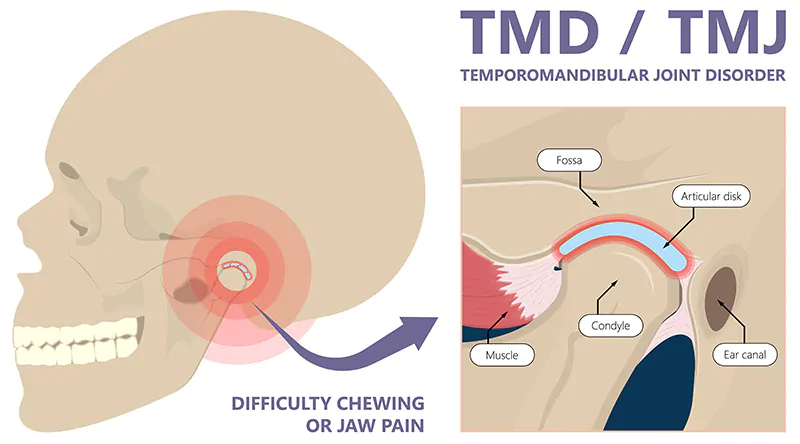tmj disorder treatment